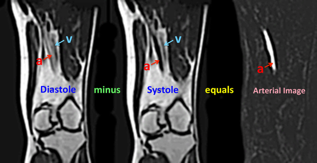 Gated 3D-FSE MRA