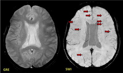 SWI (susceptibility-weighted imaging) vs T2* GRE